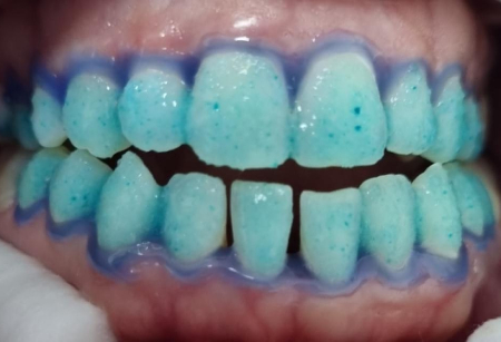 procedimiento blanqueamiento dental profesional blanqueamiento-dental-profesional