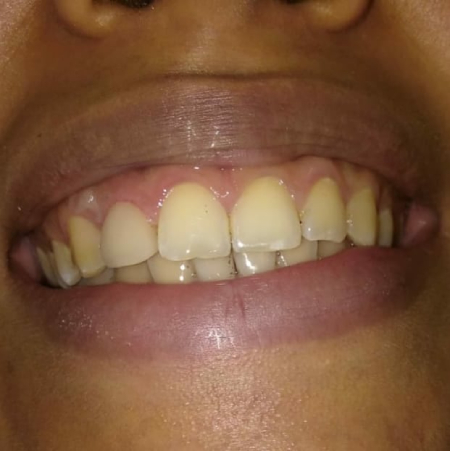 tratamiento estético con carillas dentales carillas-dentales-sonrisa