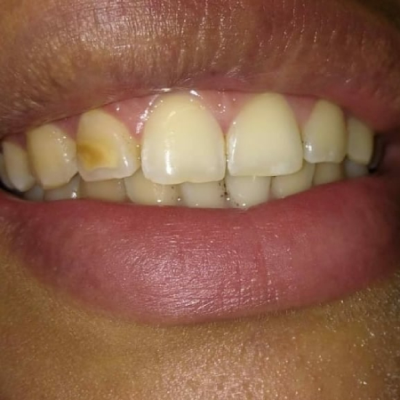 tratamiento estético con carillas dentales carillas-dentales-sonrisa