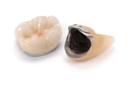 corona-dental-metaloceramica