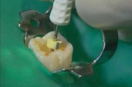 endodoncia mecanizada tratamiento de conducto endodoncia-mecanizada