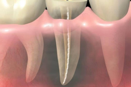 endodoncia mecanizada tratamiento de conducto endodoncia-raices