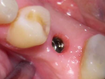 implante-dental-cicatrización