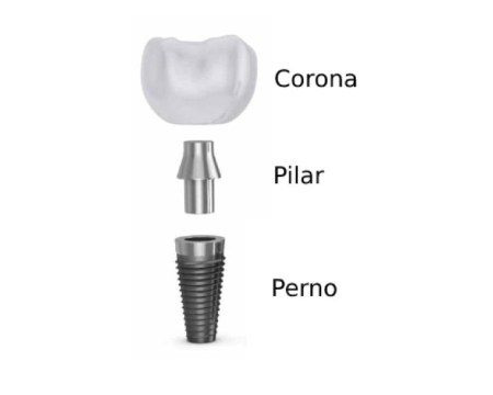 implante-dental-partes
