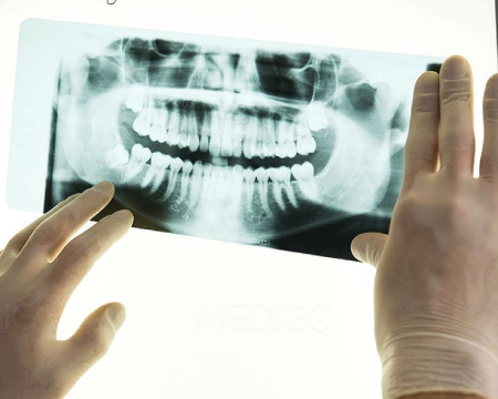 implante-dental-radiografía