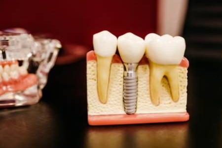 implantes-dentales