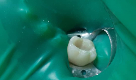 incrustación de porcelana restauración dental incrustación-dental-porcelana
