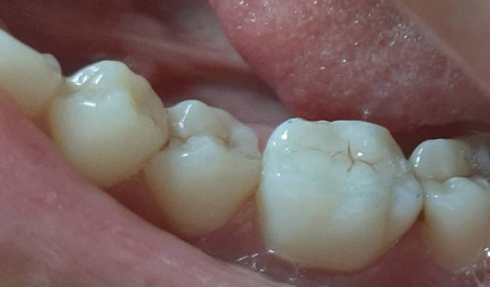 incrustación-dental-resultados