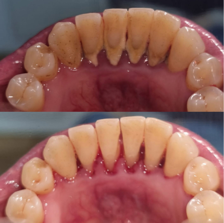 antes y después limpieza dental con ultrasonido limpieza-dental-ultrasonido-antes-despues