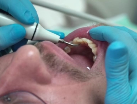 limpieza-dental-profesional