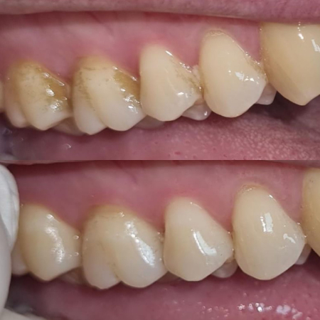 resultados limpieza dental profesional con ultrasonido limpieza-dental-ultrasonido-resultados