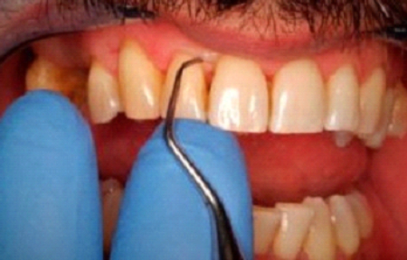 limpieza-periodontal