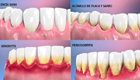 periodoncia-sintomas