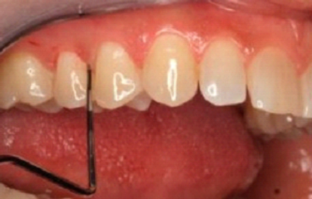 periodontitis-limpieza