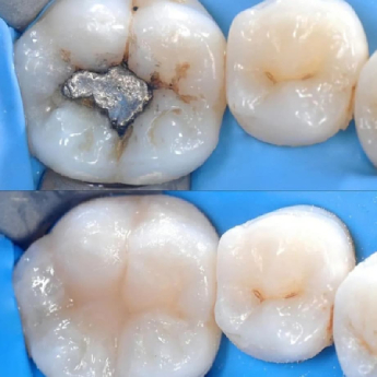 restauración-dental-resina